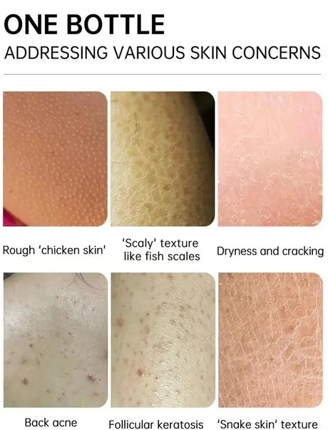 Keratosis Pilaris Repair Treatment Cream Exfoliating Removal Chicken Skin Cleaning Acne Spots Moisturizing Smooth Body Skin Care