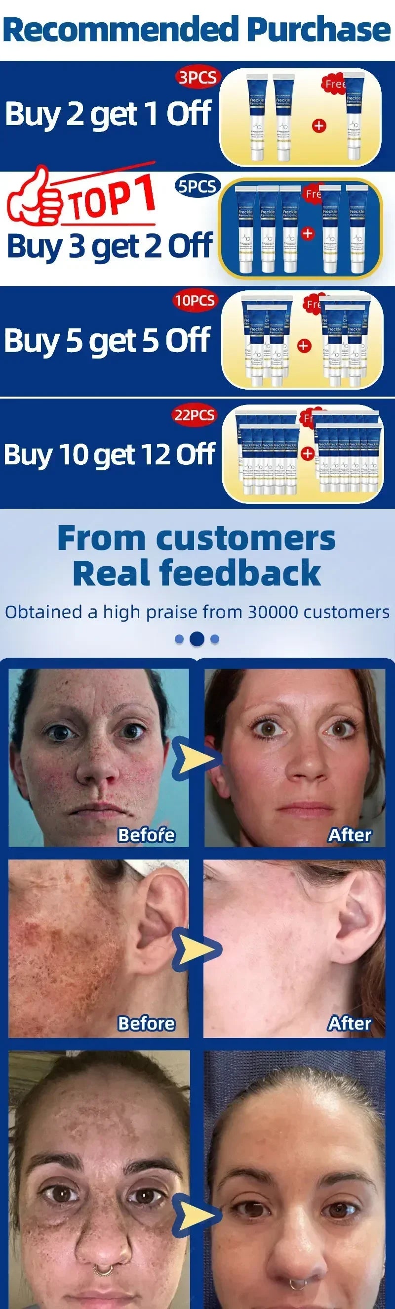 Dark Spot Remover for Face Removing Freckle Chloasma Senile Plaques Sunburn Cyasma Chorioplaque Freckle Cream