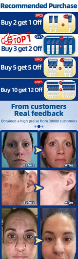 Dark Spot Remover for Face Removing Freckle Chloasma Senile Plaques Sunburn Cyasma Chorioplaque Freckle Cream