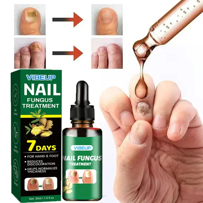 7 Days Nail Fungus Treatment Serum Ginger Anti-infective Paronychia Onychomycosis Toe Foot Nail Fungal Repair Gel Hand Foot Care