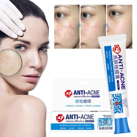 Herbal Acne Removal Face Cream Clears Pimple Scar Black Dots Gel Acne Treatment Shrink Pore Skin Whitening Lightening Ointment