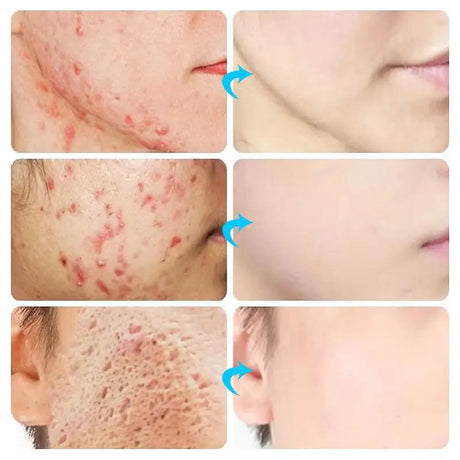 Salicylic Acid Acne Treatment Cream Repair Pimple Spots Deep Cleaning Pore Shrinking Anti-acne Oil Control Moisturizer Skin Care