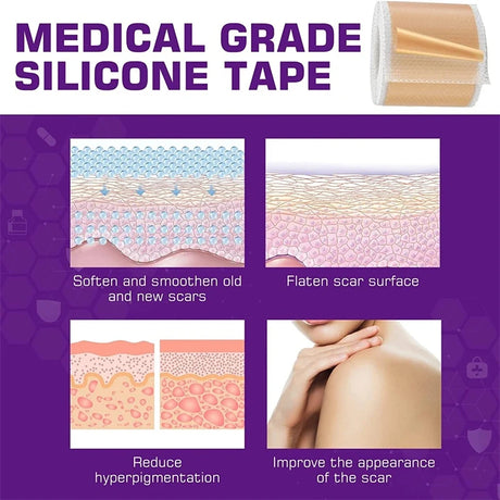 Silicone Scar Sheets - Reusable Scar Tape for Keloid, C-Section, Surgery, Burn, Acne - Waterproof, Hypoallergenic, Latex-Free