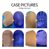 NEW Professional Dermatoscope Skin Medical Magnifier Detection Woods Lamp UVA Lamp For Vitiligo Detection