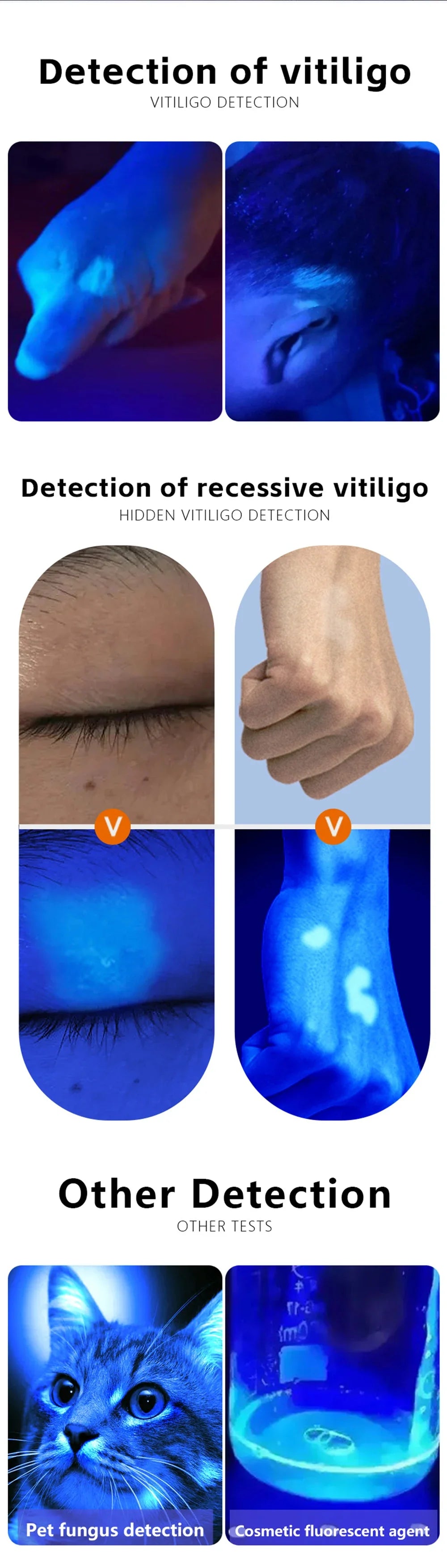 NEW Professional Dermatoscope Skin Medical Magnifier Detection Woods Lamp UVA Lamp For Vitiligo Detection