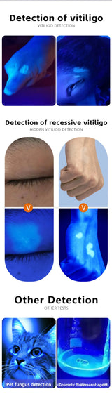 NEW Professional Dermatoscope Skin Medical Magnifier Detection Woods Lamp UVA Lamp For Vitiligo Detection