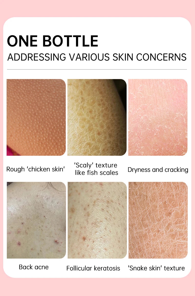Chicken Skin Removal Cream Body Curing Keratosis Follicle Pore Spot Dull Treatment Whitening Moisturizing Body Care JoyPretty
