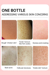 Chicken Skin Removal Cream Body Curing Keratosis Follicle Pore Spot Dull Treatment Whitening Moisturizing Body Care JoyPretty