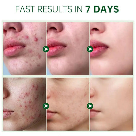 Salicylic Acid Acne Treatment Cream Repair Pimple Spots Deep Cleaning Pore Shrinking Anti-acne Oil Control Moisturizer Skin Care