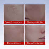 SADOER Anti Freckle Cream Face Brightening Creams Spot Removing Anti-aging Moisturizing Freckles Removal Facial Cream Skin Care