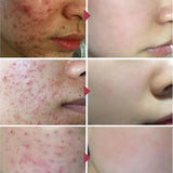 Salicylic Acid Acne Treatment Cream Repair Pimple Spots Deep Cleaning Pore Shrinking Anti-acne Oil Control Moisturizer Skin Care