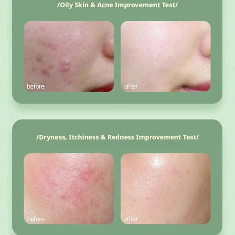 Aloe Vera Gel Moisturizing Face Body Cream Sunburn Repair Hydrating Soothing After Sun Acne Treatment Sensitive Skin Care