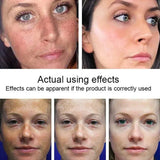 Dark Spots Remover Whitening Face Set Freckle Melanin Correcting Reduce Fine Lines Brighten Essence Korean Beauty Skin Care ﻿