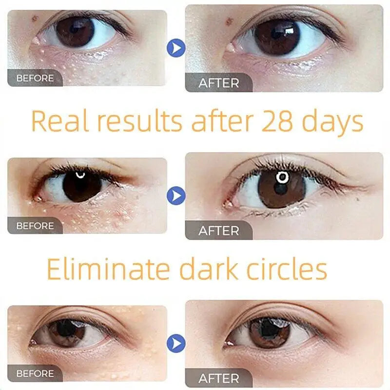Fat Granules Remover Eye Cream Anti-Puffiness Anti Inflammatory Reduce Dark Circles Eyebags Fade Lines Moisturizing Eye Care