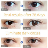 Fat Granules Remover Eye Cream Anti-Puffiness Anti Inflammatory Reduce Dark Circles Eyebags Fade Lines Moisturizing Eye Care