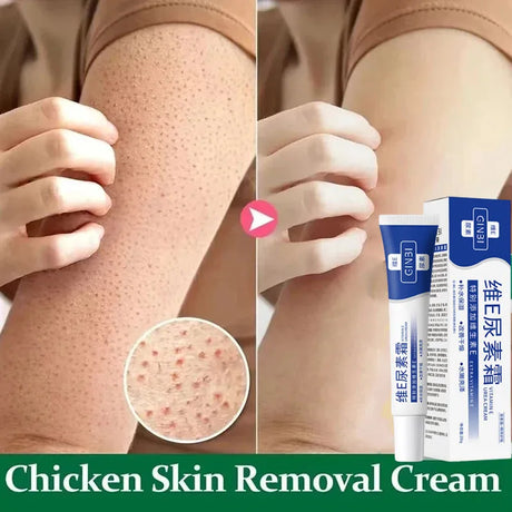 Keratosis Pilaris Repair Treatment Cream Exfoliating Removal Chicken Skin Cleaning Acne Spots Moisturizing Smooth Body Skin Care