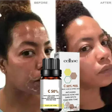 High Quality 50% Chemical Peel Acid Skin Superforce Pigmentation Lightening Melanin Acne Treatment Remove Scar