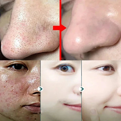 Original Facial Remove Blackhead Green Tea Solid Mask Treat Acne Blemish Black Dots Clean Stick Cream Shrink Pores Skin Care