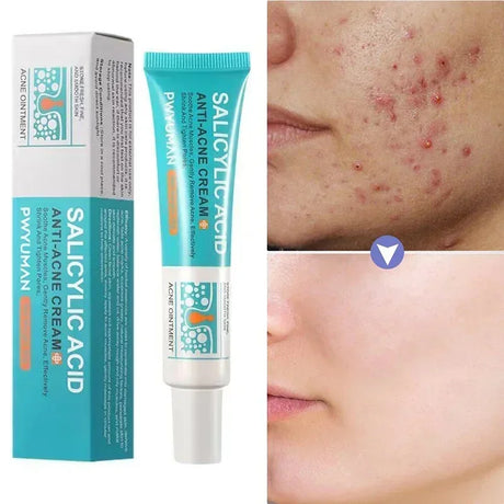 Salicylic Acid Acne Treatment Face Cream Repair Pimple Spots Deep Cleaning Pore Anti-acne Scar Oil Control Moisturizer Skin Care