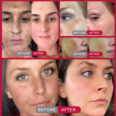 Powerful Dark Spots Remover Whitening Serum Face Freckle Melanin Correcting Anti Pigmentation Brighten Skin Beauty Care Products