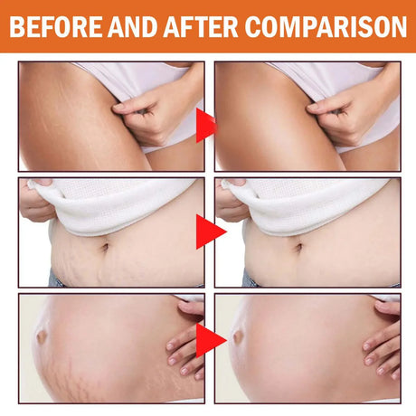 TRSTAY Stretch Mark Scar Repair Cream Enhances Skin Elasticity Moisture Collagen Improvement Safe And Effective