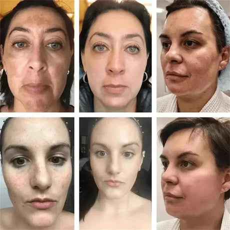 Dark Spots Removal Cream Facial Whitening Freckle Acne Mark Pigmentation Removal Melanin Skin Correction Brighten Care Products