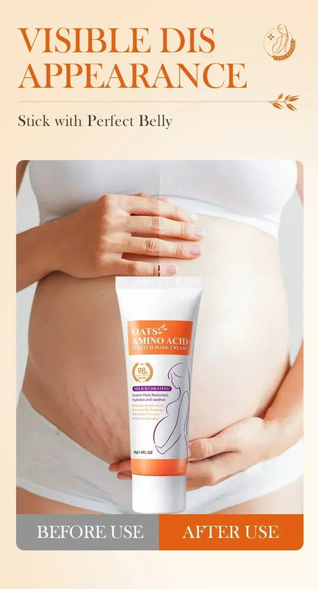 Cream For Pregnancy Stretch Marks Removal Eliminate Red White Old Stretch Marks  2025