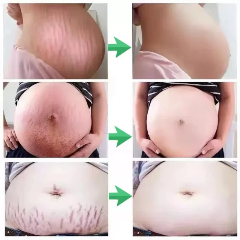 Snail Removes Stretch Mark Cream To Remove Postpartum Obesity Pregnant Women Repair Anti-Aging Anti-Winkles Firming Body Cream