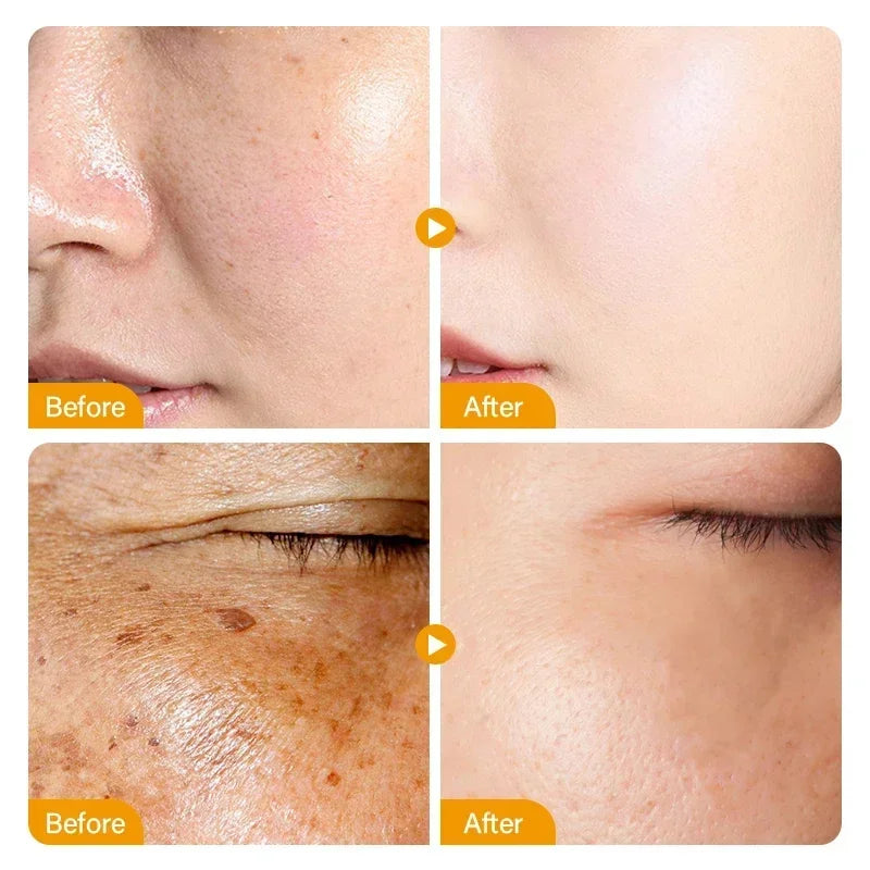 Dark Spots Remover Whitening Face Set Freckle Melanin Correcting Reduce Fine Lines Brighten Essence Korean Beauty Skin Care ﻿