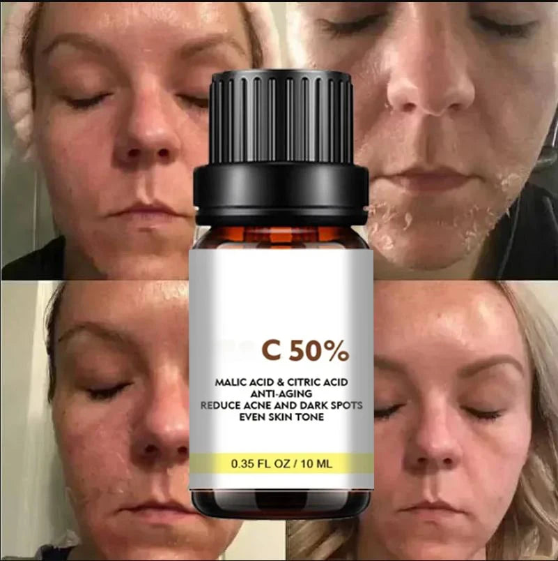 High Quality 50% Chemical Peel Acid Skin Superforce Pigmentation Lightening Melanin Acne Treatment Remove Scar