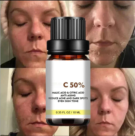 High Quality 50% Chemical Peel Acid Skin Superforce Pigmentation Lightening Melanin Acne Treatment Remove Scar