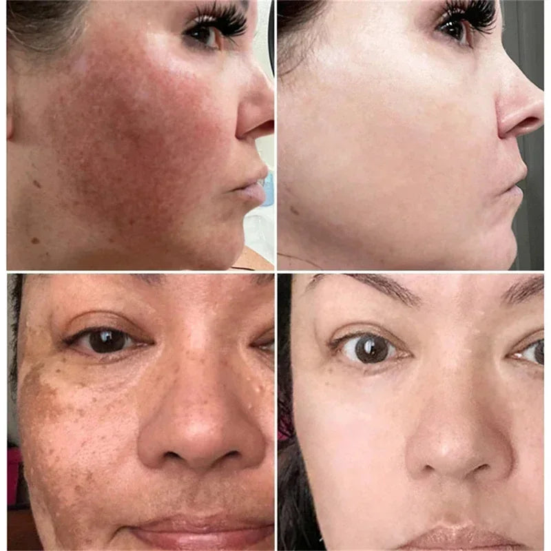 Powerful Spot-Removing Whiten Cream Brighten Skin Fast Eliminates Melanin Pigmentation Melasma Dark Spots Korean Face Skin Care