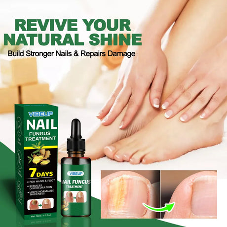 7 Days Nail Fungus Treatment Serum Ginger Anti-infective Paronychia Onychomycosis Toe Foot Nail Fungal Repair Gel Hand Foot Care