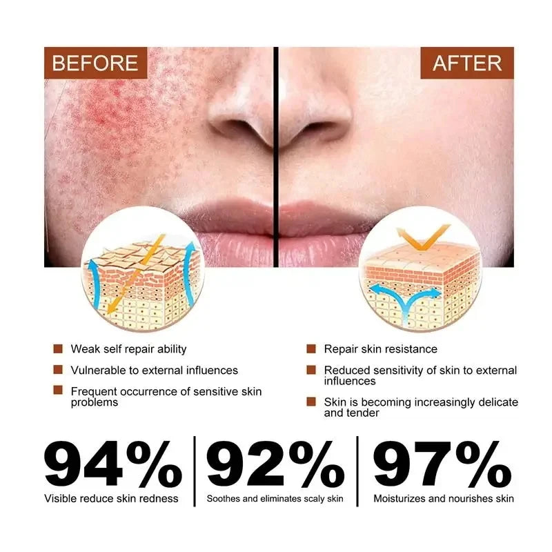 Facial Redness Repair Cream Improve Sensitive Skin Dryness Hydrating Sooth Lotion Removal Rosacea Day Night Korean Cosmetics