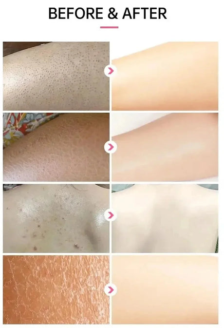 Keratosis Pilaris Repair Treatment Cream Exfoliating Removal Chicken Skin Cleaning Acne Spots Moisturizing Smooth Body Skin Care