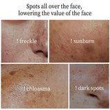 Powerful Spot-removing Whitening Freckles Cream Remove Melasma Dark Spots Fade Pigmentation Acne Moisturizing Brighten Skin Care