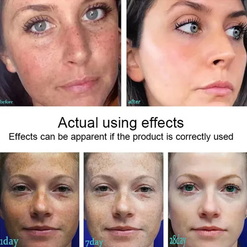 Powerful Spot-removing Whitening Freckles Cream Remove Melasma Dark Spots Fade Pigmentation Acne Moisturizing Brighten Skin Care