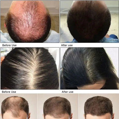 Hair Growth Serum 7 Days Fast Regrowth Essential Capsule Anti Hair Loss Baldness Repair Damaged Scalp Treatment For Women Men