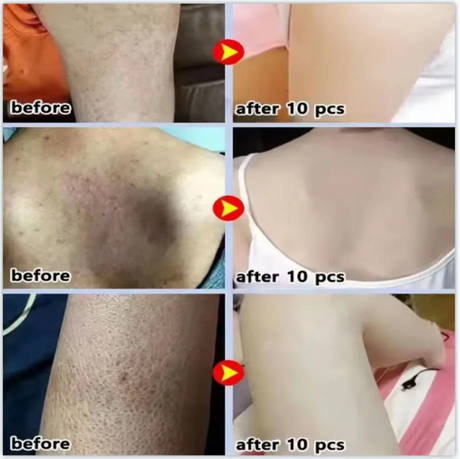 Keratosis Pilaris Repair Treatment Cream Exfoliating Removal Chicken Skin Cleaning Acne Spots Moisturizing Smooth Body Skin Care