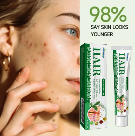 Anti-Acne Cream Effectively Removes Skin Nodules Pustules Cysts Papules Blackheads Men And Women Acne Skin Care Essence Cream