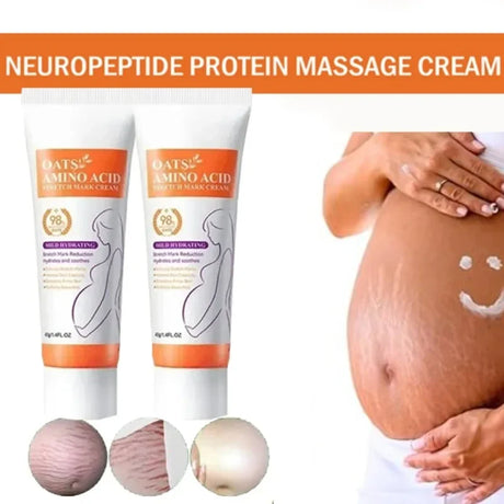 Cream For Pregnancy Stretch Marks Removal Eliminate Red White Old Stretch Marks  2025