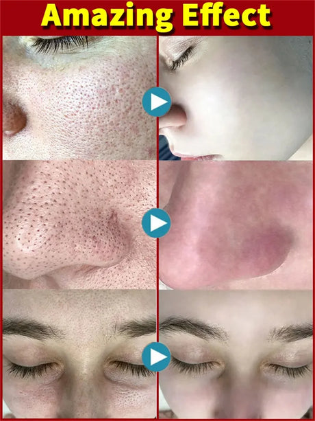Salicylic Acid Pore Shrinking Cream Quick Elimination Large Pores Remove Blackehead Tighten Face Smooth Skin Korean Care Product