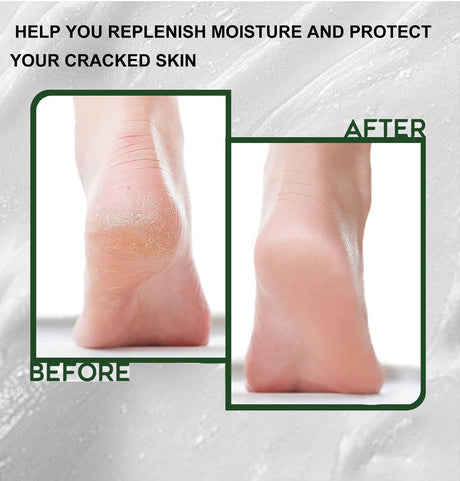 40% Urea Foot Cream Stick - Moisturizing & Exfoliating Cracked Heel Repair Deep Hydration for Dry Feet Long protect