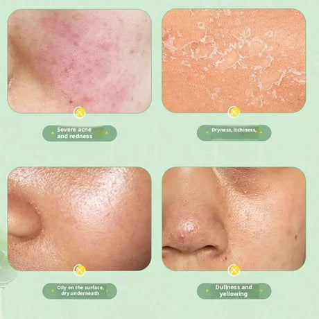 Aloe Vera Gel Moisturizing Face Body Cream Sunburn Repair Hydrating Soothing After Sun Acne Treatment Sensitive Skin Care