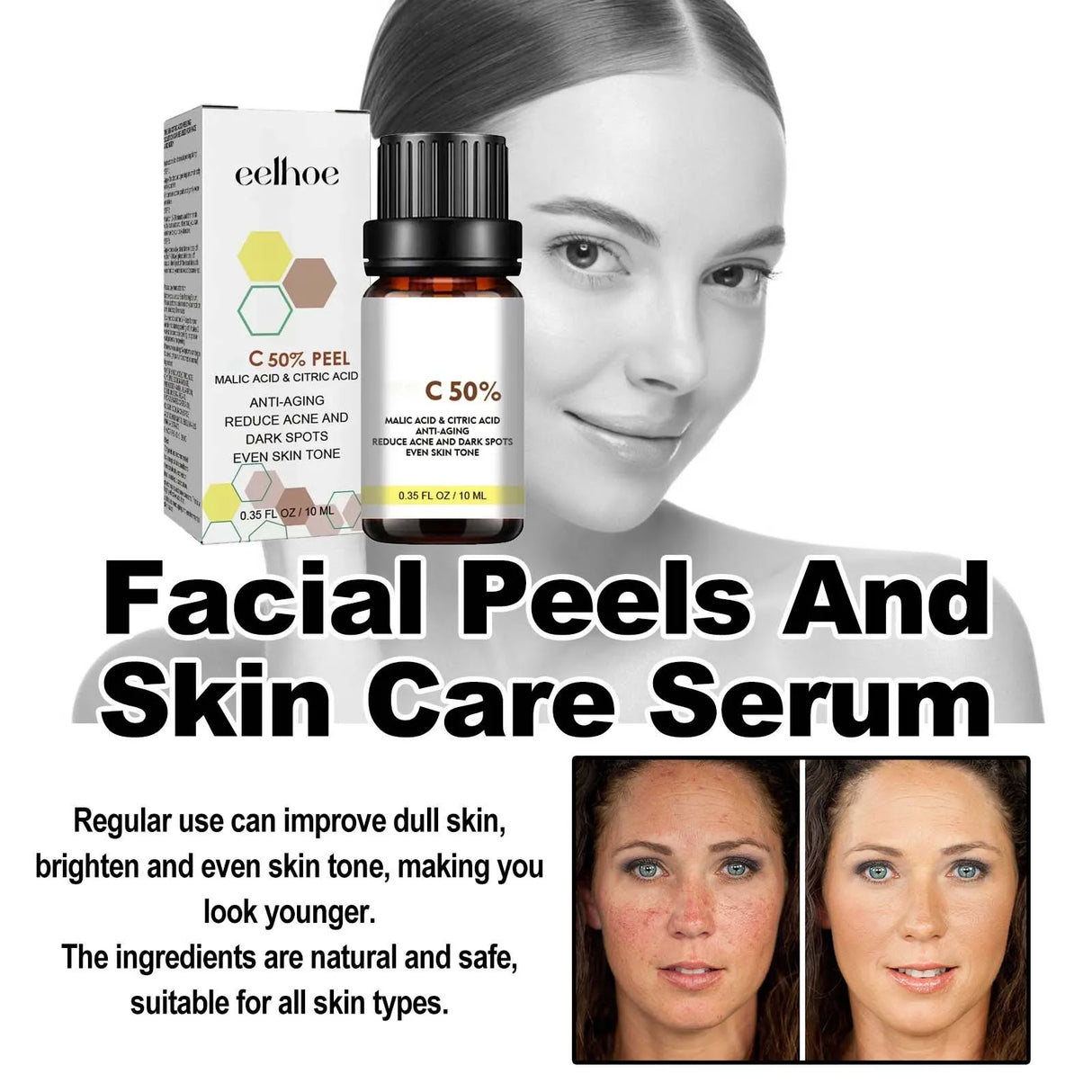 High Quality 50% Chemical Peel Acid Skin Superforce Pigmentation Lightening Melanin Acne Treatment Remove Scar