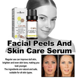 High Quality 50% Chemical Peel Acid Skin Superforce Pigmentation Lightening Melanin Acne Treatment Remove Scar