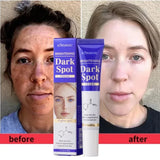 Dark Spots Removal Cream Facial Whitening Freckle Acne Mark Pigmentation Removal Melanin Skin Correction Brighten Care Products