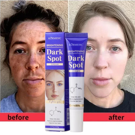 Dark Spots Removal Cream Facial Whitening Freckle Acne Mark Pigmentation Removal Melanin Skin Correction Brighten Care Products