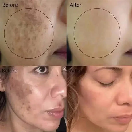 Dark Spots Removal Cream Facial Whitening Freckle Acne Mark Pigmentation Removal Melanin Skin Correction Brighten Care Products