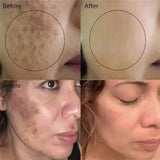Powerful Spot-Removing Whiten Cream Brighten Skin Fast Eliminates Melanin Pigmentation Melasma Dark Spots Korean Face Skin Care